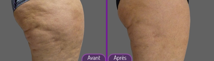 cryolipolyse-grenoble-woodward-09